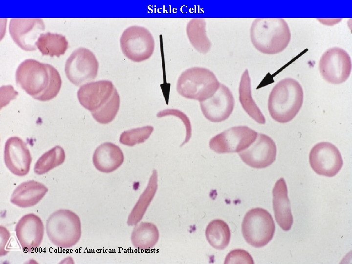 Sickle Cells © 2004 College of American Pathologists 