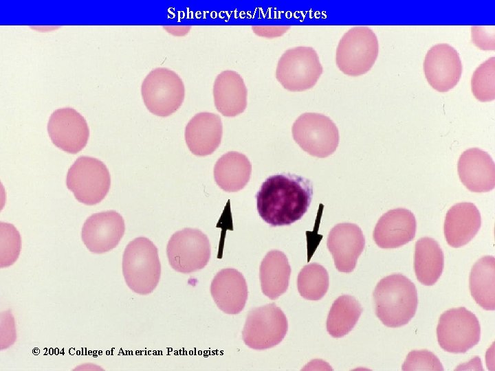Spherocytes/Mirocytes © 2004 College of American Pathologists 