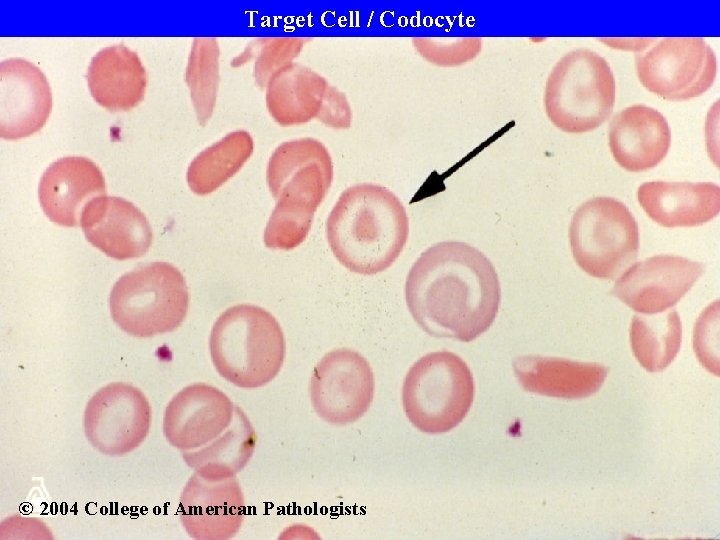 Target Cell / Codocyte © 2004 College of American Pathologists 