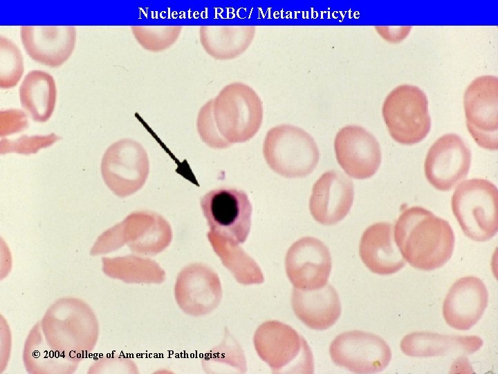 Nucleated RBC/ Metarubricyte © 2004 College of American Pathologists 
