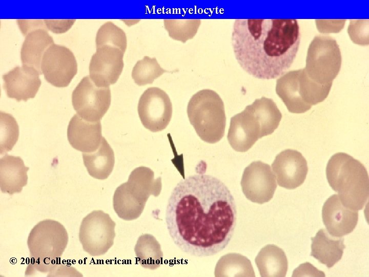 Metamyelocyte © 2004 College of American Pathologists 