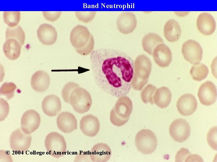 Band Neutrophil © 2004 College of American Pathologists 