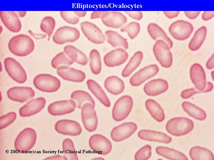 Elliptocytes/Ovalocytes © 2003 American Society for Clinical Pathology 