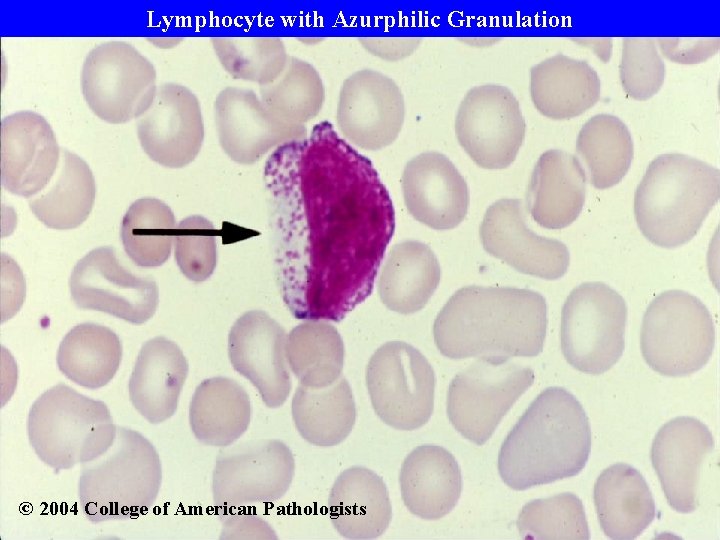 Lymphocyte with Azurphilic Granulation © 2004 College of American Pathologists 