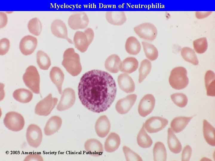 Myelocyte with Dawn of Neutrophilia © 2003 American Society for Clinical Pathology 