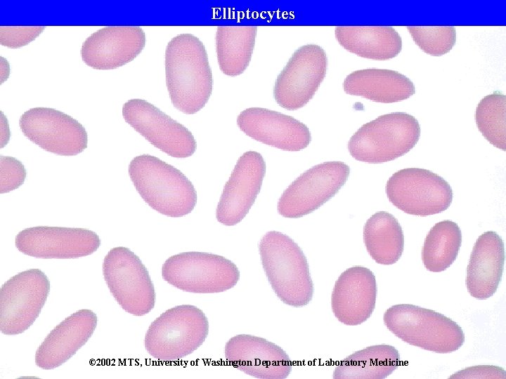 Elliptocytes © 2002 MTS, University of Washington Department of Laboratory Medicine 