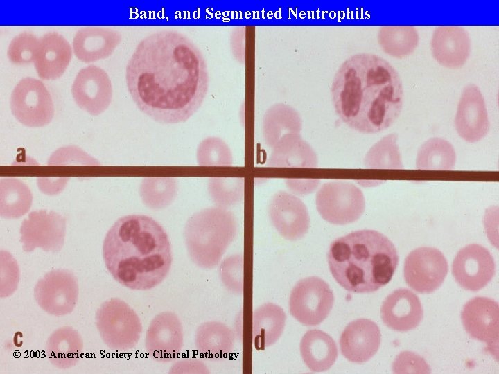 Band, and Segmented Neutrophils © 2003 American Society for Clinical Pathology 