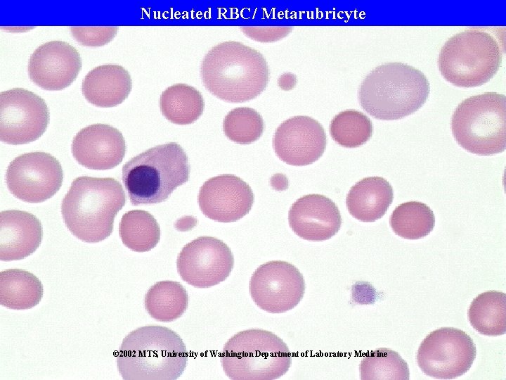 Nucleated RBC/ Metarubricyte © 2002 MTS, University of Washington Department of Laboratory Medicine 