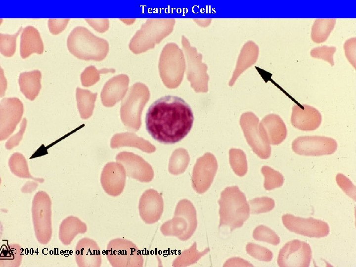 Teardrop Cells © 2004 College of American Pathologists 