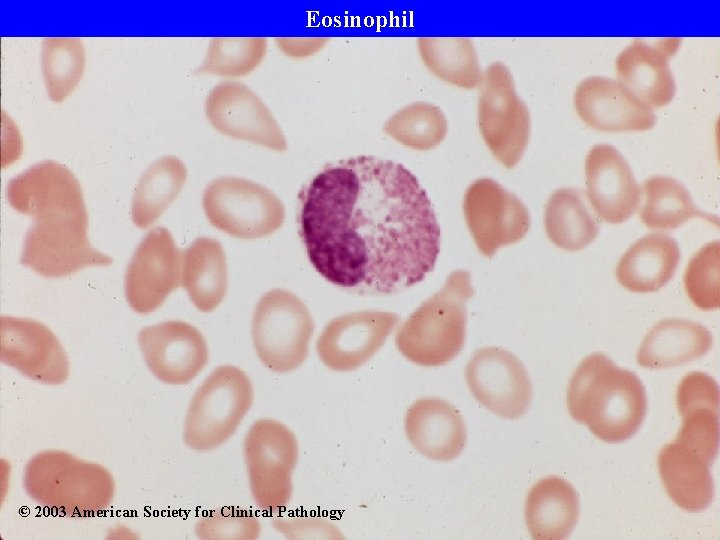 Eosinophil © 2003 American Society for Clinical Pathology 
