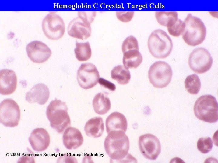 Hemoglobin C Crystal, Target Cells © 2003 American Society for Clinical Pathology 