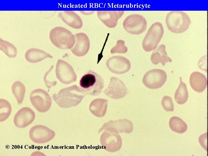 Nucleated RBC/ Metarubricyte © 2004 College of American Pathologists 