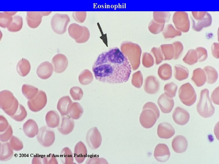 Eosinophil © 2004 College of American Pathologists 