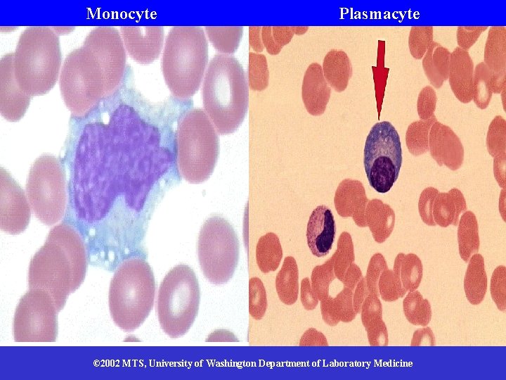 Monocyte Plasmacyte © 2002 MTS, University of Washington Department of Laboratory Medicine 