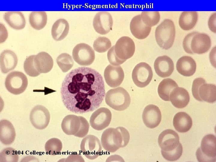 Hyper-Segmented Neutrophil © 2004 College of American Pathologists 