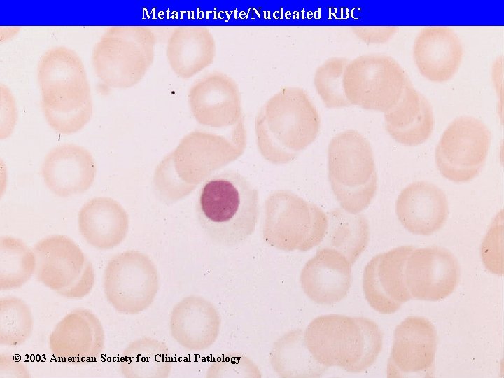Metarubricyte/Nucleated RBC © 2003 American Society for Clinical Pathology 