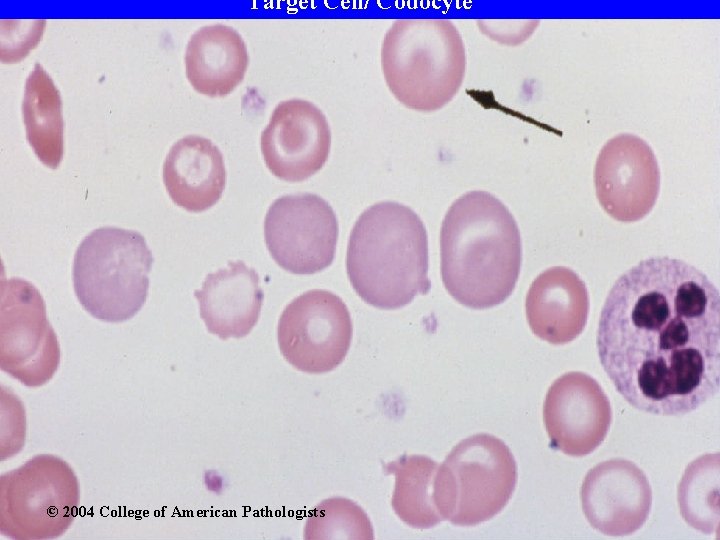 Target Cell/ Codocyte © 2004 College of American Pathologists 