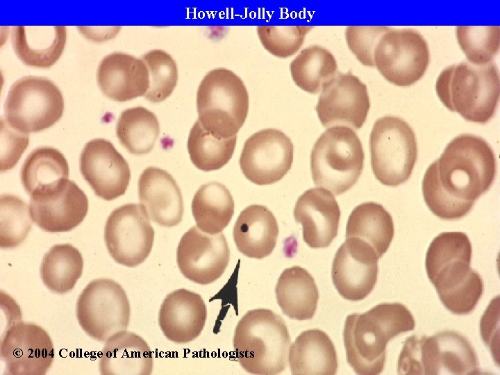 Howell-Jolly Body © 2004 College of American Pathologists 
