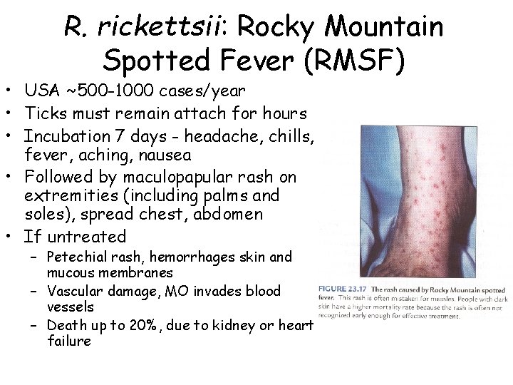 R. rickettsii: Rocky Mountain Spotted Fever (RMSF) • USA ~500 -1000 cases/year • Ticks
