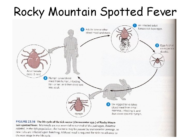 Rocky Mountain Spotted Fever 