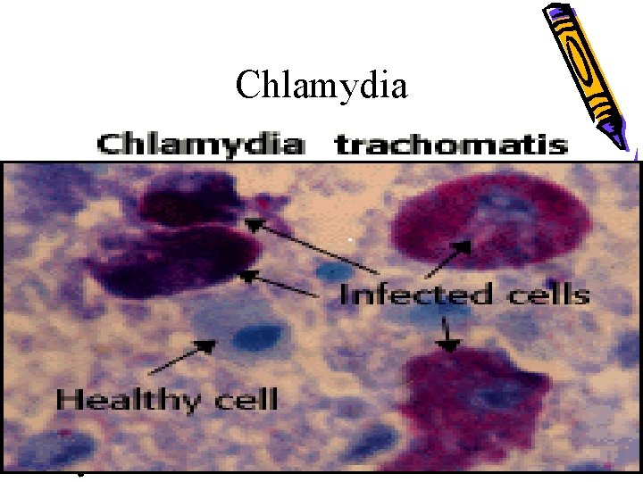 Chlamydia 