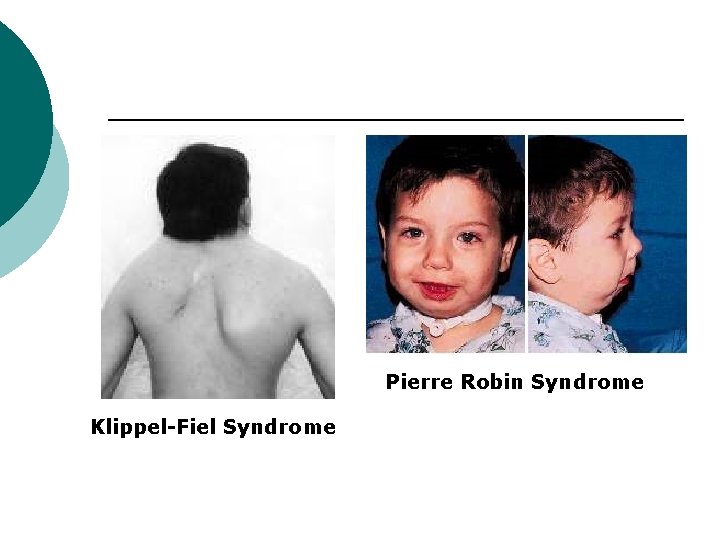 Pierre Robin Syndrome Klippel-Fiel Syndrome 