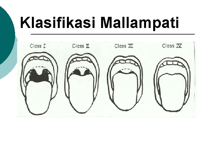 Klasifikasi Mallampati 