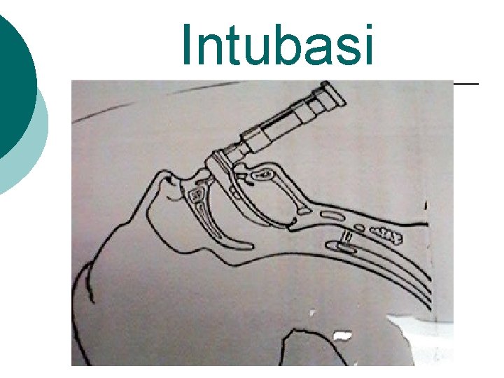 Intubasi 