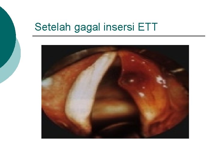 Setelah gagal insersi ETT 