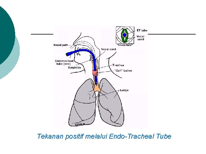 Tekanan positif melalui Endo-Tracheal Tube 