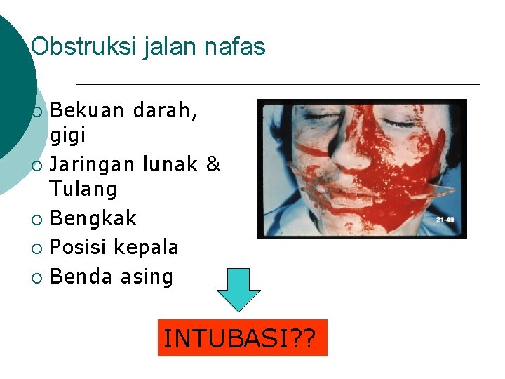 Obstruksi jalan nafas Bekuan darah, gigi ¡ Jaringan lunak & Tulang ¡ Bengkak ¡