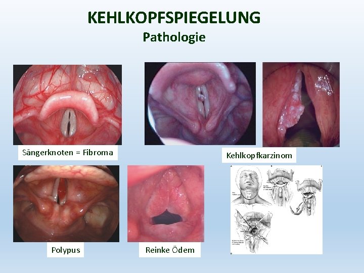 KEHLKOPFSPIEGELUNG Pathologie Sängerknoten = Fibroma Polypus Kehlkopfkarzinom Reinke Ödem 