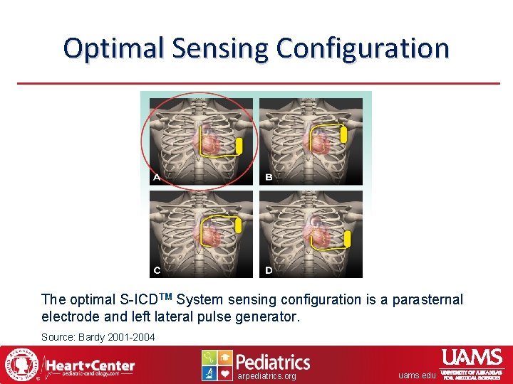 Optimal Sensing Configuration The optimal S-ICDTM System sensing configuration is a parasternal electrode and