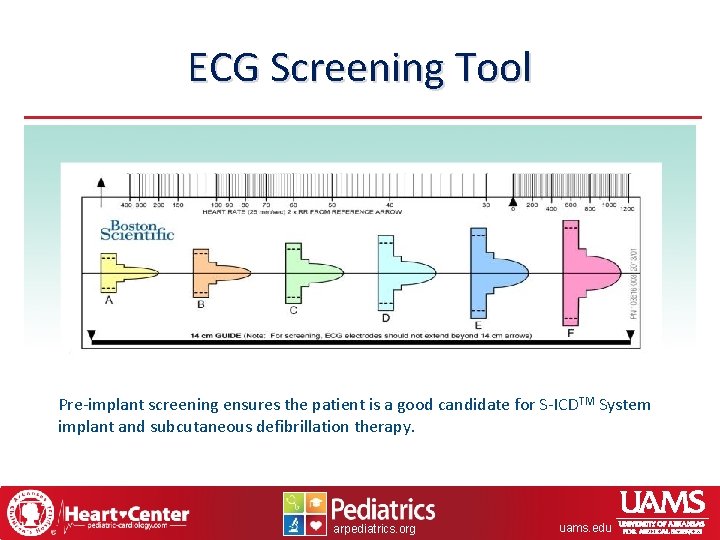 ECG Screening Tool Pre-implant screening ensures the patient is a good candidate for S-ICDTM