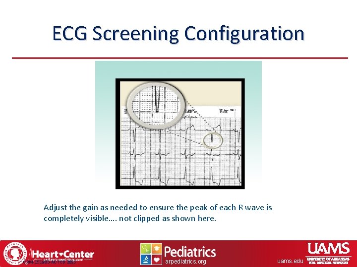 ECG Screening Configuration Adjust the gain as needed to ensure the peak of each