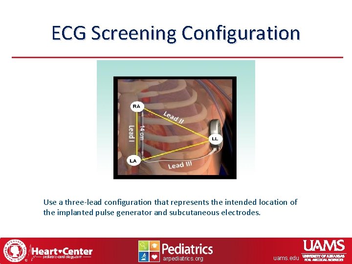 ECG Screening Configuration Use a three-lead configuration that represents the intended location of the