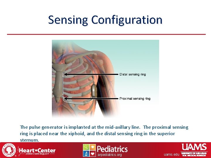 Sensing Configuration The pulse generator is implanted at the mid-axillary line. The proximal sensing
