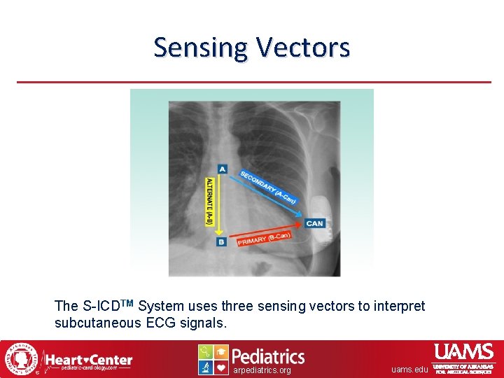 Sensing Vectors The S-ICDTM System uses three sensing vectors to interpret subcutaneous ECG signals.