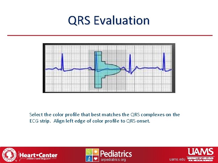 QRS Evaluation Select the color profile that best matches the QRS complexes on the