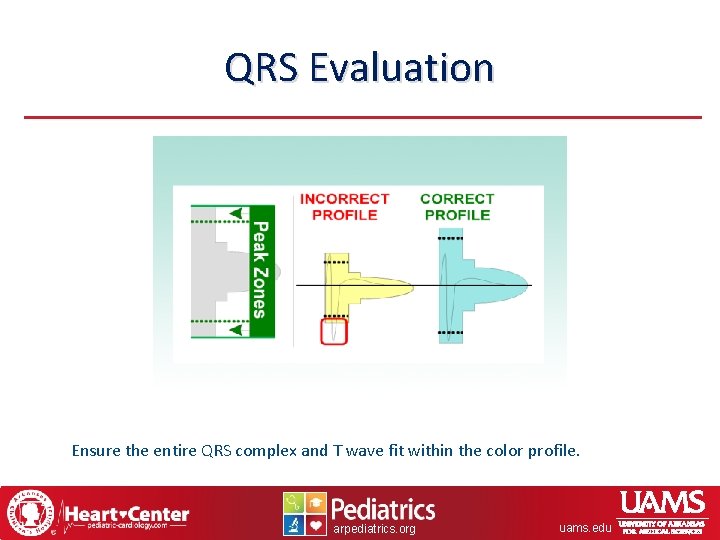 QRS Evaluation Ensure the entire QRS complex and T wave fit within the color