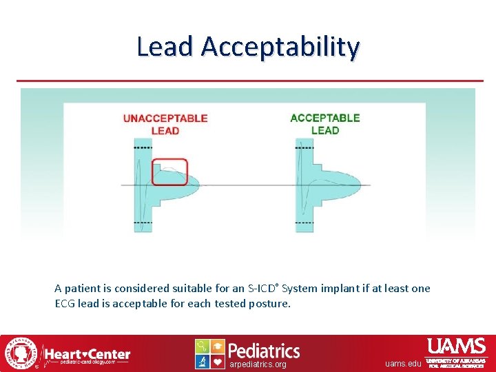Lead Acceptability A patient is considered suitable for an S-ICD® System implant if at
