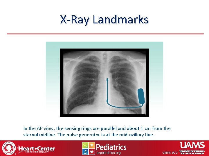 X-Ray Landmarks In the AP view, the sensing rings are parallel and about 1