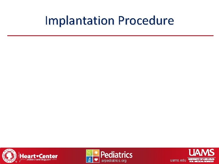 Implantation Procedure arpediatrics. org uams. edu 