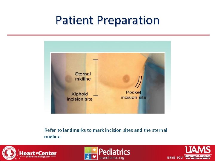 Patient Preparation Refer to landmarks to mark incision sites and the sternal midline. arpediatrics.