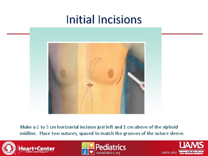 Initial Incisions Make a 2 to 3 cm horizontal incision just left and 1