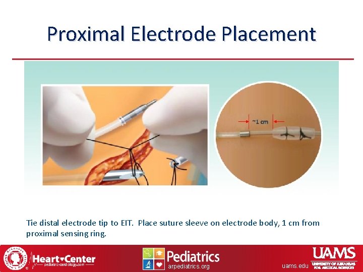 Proximal Electrode Placement Tie distal electrode tip to EIT. Place suture sleeve on electrode