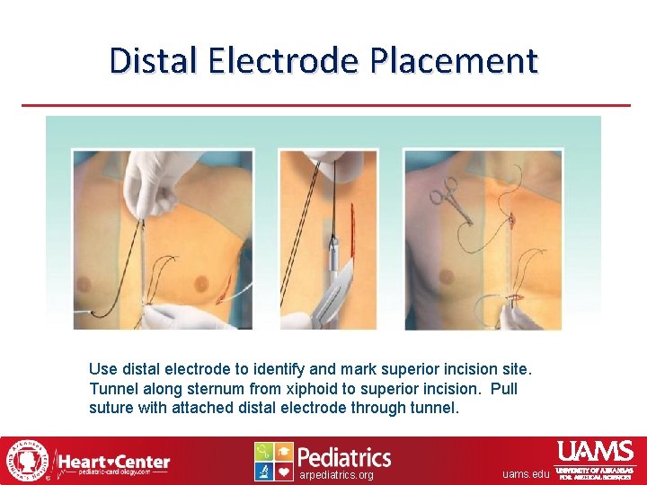 Distal Electrode Placement Use distal electrode to identify and mark superior incision site. Tunnel