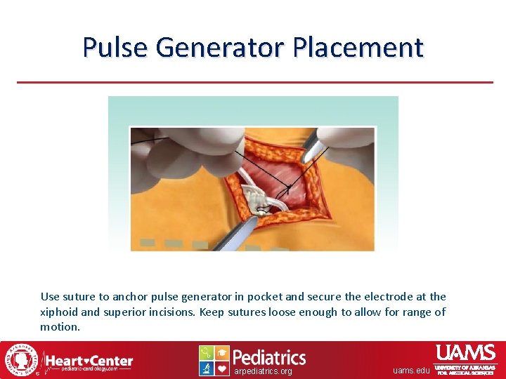 Pulse Generator Placement Use suture to anchor pulse generator in pocket and secure the