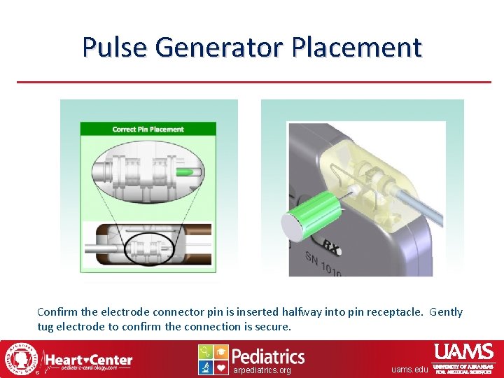 Pulse Generator Placement Confirm the electrode connector pin is inserted halfway into pin receptacle.