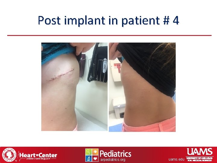 Post implant in patient # 4 arpediatrics. org uams. edu 